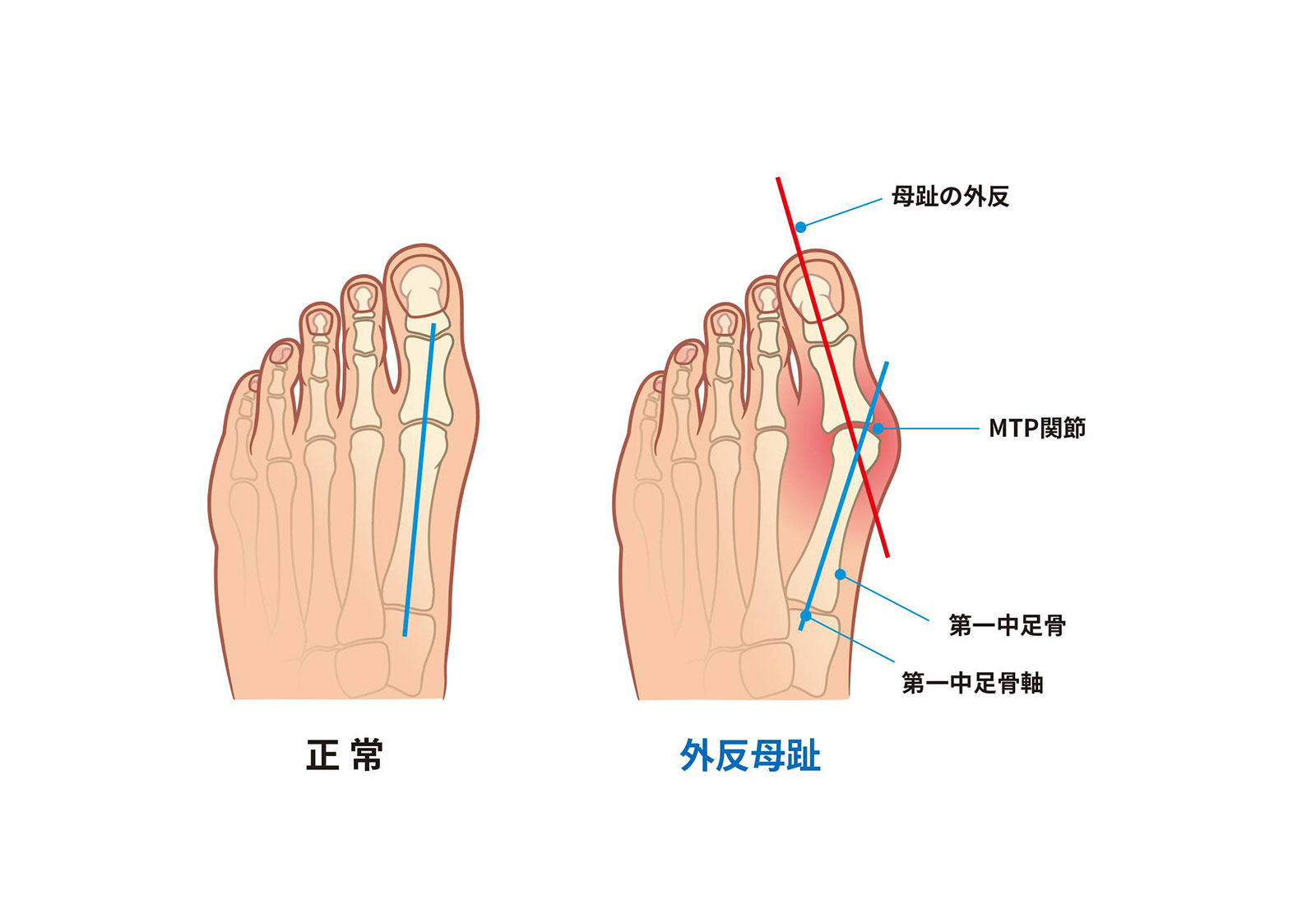 ⑥ 症状について知る(外反母趾)とは?
